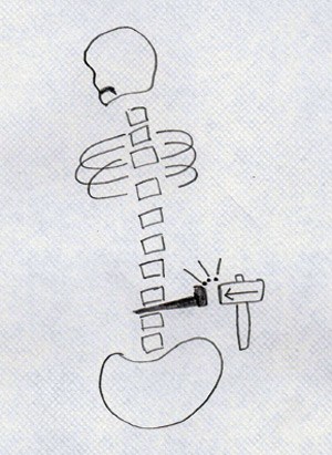 Patient art herniated spinal disc