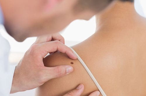 Doctor checking patient for melanoma skin cancer