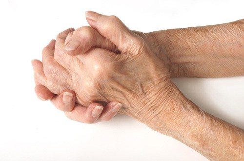 AbbVie: UK patients want better arthritis care