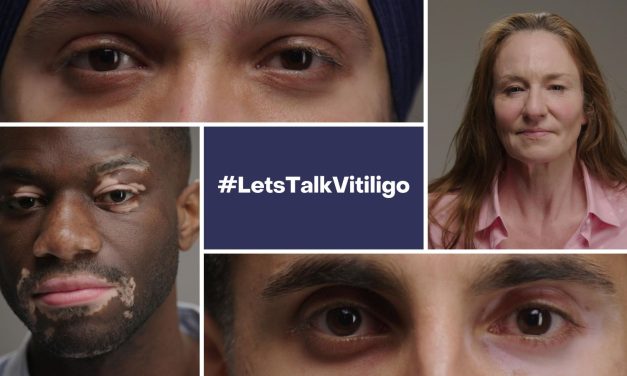 UK survey reveals two-thirds of vitiligo patients struggle with mental health