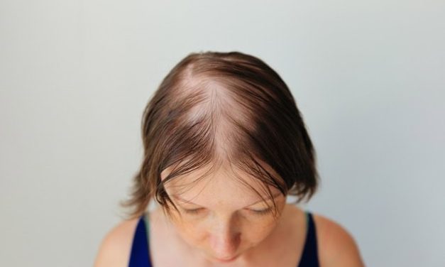 MHRA approves Leqselvi for severe alopecia areata