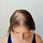 Veradermics’ oral treatment for female pattern hair loss delivers positive study results