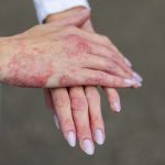 First-ever World Chronic Hand Eczema Day launches on 5 October