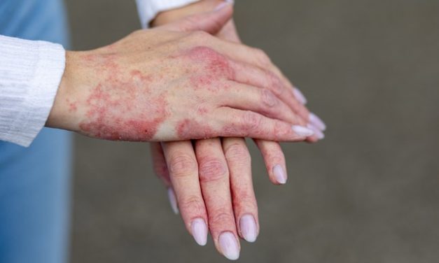 First-ever World Chronic Hand Eczema Day launches on 5 October